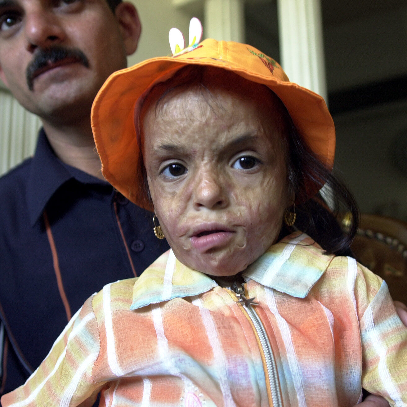 Teba Furat, 4, with her father Fahdel, 27, in Baghdad, Iraq, on June 5, 2006.  Teba suffered second degree burns on her face, scalp, and both hands during a roadside bombing in the provincial capital of Baquba on Sept. 2, 2003.  Fahdel worries his daughters deformities will trouble her when she begins school next year, and may burden her throughout her life if not corrected.
Iraqi plastic surgeons, once limited to correcting congenital defects and performing elective cosmetic surgery, now say they are inundated with war-related injuries.  
JAMES PALMER/FOR THE STAR-LEDGER